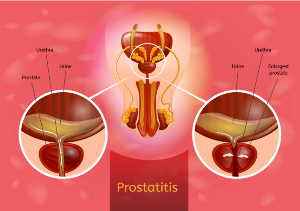 prostatita