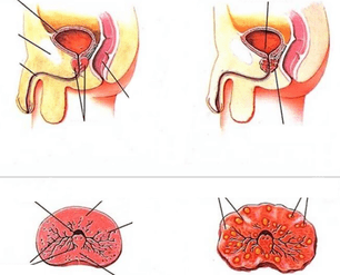 prostata normala si prostatita cronica