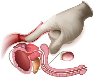 masajul prostatei