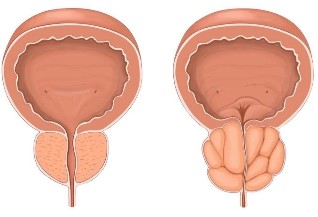 Prostatita