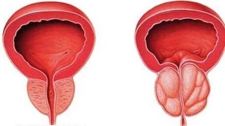 prostata normala si inflamata