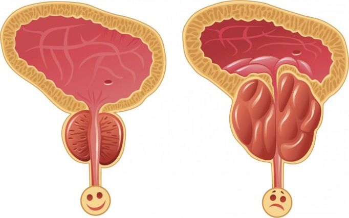 prostată sănătoasă și inflamată cu prostatită