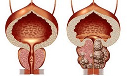 Sănătoasă și nesănătoasă prostata