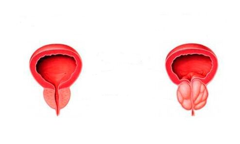 prostată sănătoasă și inflamată cu prostatită