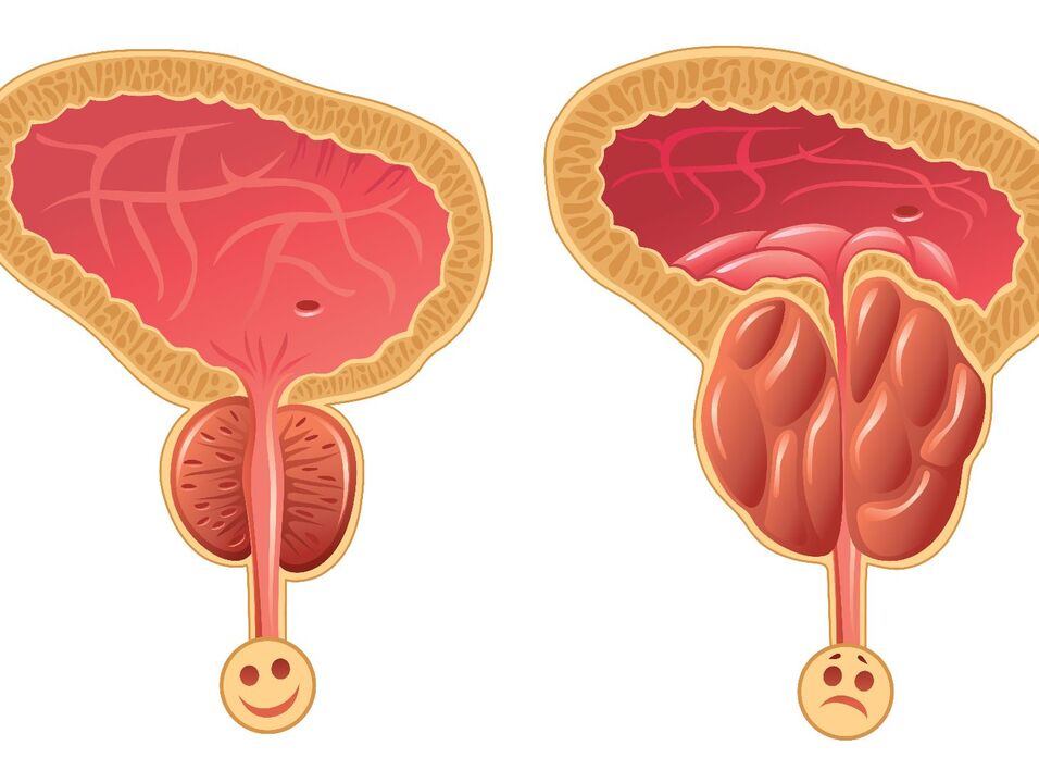 Glanda prostatică sănătoasă și congestia prostatei cu prostatita congestivă