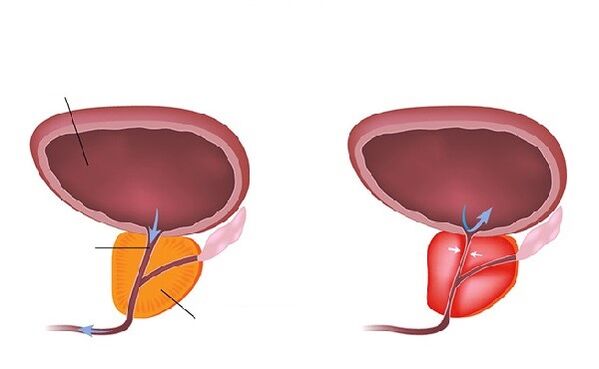 prostata normala si inflamata